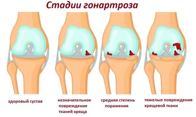 Артроскопия голеностопного сустава