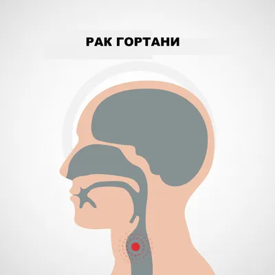 Хриплый голос и проблемы с горлом могут указывать на болезни ЖКТ |  ФедералПресс | Дзен