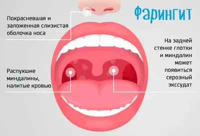 Фарингит: признаки, симптомы, лечение - МедКом