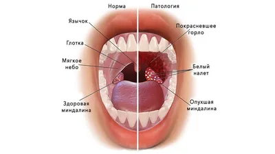 Фарингит: причины возникновения, описание симптомов, диагностика и лечение  - MEDСЕМЬЯ