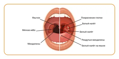 Что это в горле? очень болит и больно глотать, болит язычок и белая язва во  рту | Пикабу
