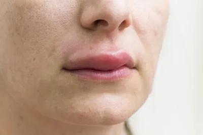 Расстройства и болезни губ : Концепция пятна Fordyce и как ее предотвратить  Стоковое Изображение - изображение насчитывающей условие, она: 210807835