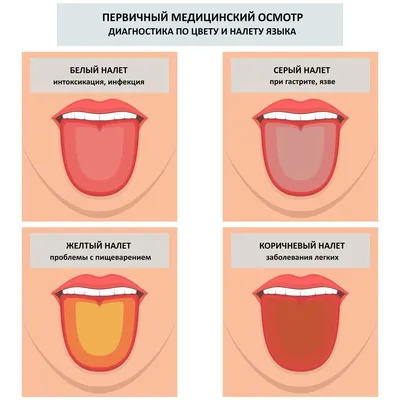 Глоссит симптомы, диагностика, причины, лечение