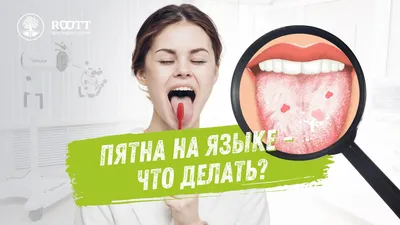 Язвочки на языке которые имеют белый налет, ощущается жжение, фото - форум  Стоматология.Су