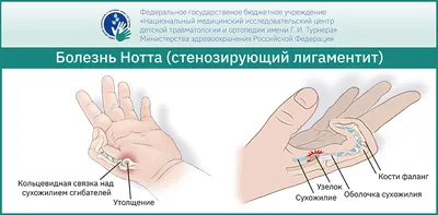 Травмы: разрывы связок кисти, растяжения, воспаления, надрывы связок на  пальцах, запястье руки – Симптомы, лечение, восстановление