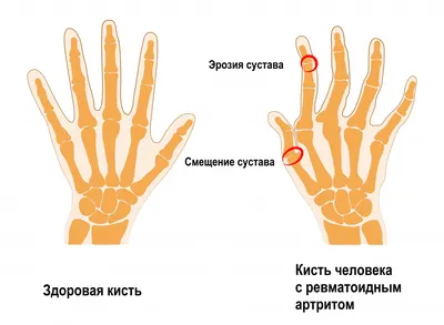 Боль в суставах кистей рук - причины появления, при каких заболеваниях  возникает, диагностика и способы лечения