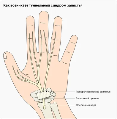 Остеопороз рук и остеопороз пальцев кисти