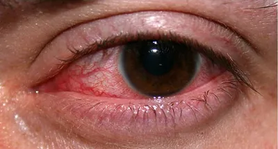 Почему дергается глаз: причины, симптомы и методы лечения глазного тика
