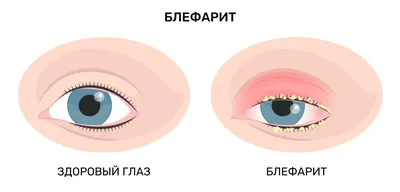 Экзема век: причины возникновения, виды заболевания и методы лечения |  PROMED