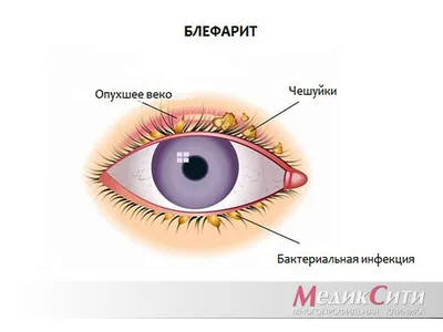 Выворот глазного века. Лечение эктропиона глаза в офтальмология