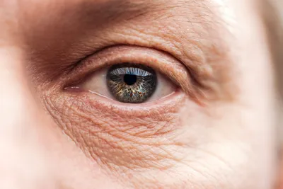 IPL М22 для лечения болезни сухого глаза - Premium Aesthetics