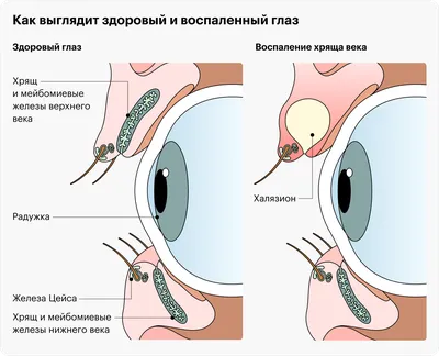 Ячмень на глазу: чем лечить, как избавиться, быстрое лечение. Как выглядит  ячмень на фото. Как убрать ячмень с глаза у ребенка