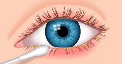 Круги под глазами — почему возникают и как их лечить | Блог | Complimed