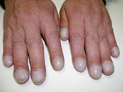Деформация ногтя: причины и лечение - Клиника ТРИНИТИ (Москва)