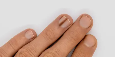 Nails master - Онихолизис — это изменения ногтя, в результате которого  ногтевая пластина отходит от ногтевого ложа. Заболевание может проявиться,  как на одном пальце, так и сразу на нескольких. Поражены могут быть