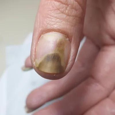 Грибок ногтей: симптомы и лечение - Клиника ТРИНИТИ (Москва)
