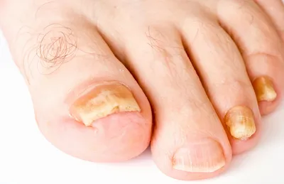 Анонихия – симптомы, причины, виды и способы лечения отсутствующего ногтя  на пальце