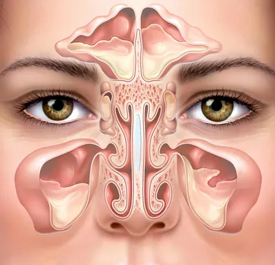 Синехии носа: лечение, причины и диагностика заболевания