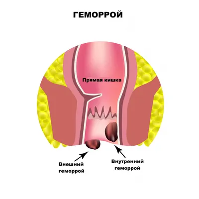 Болезни заднего прохода фото