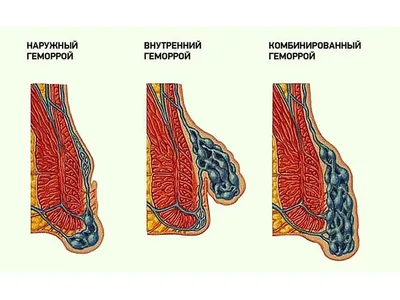 Тромбированный геморрой: причины, диагностика, симптомы и лечение