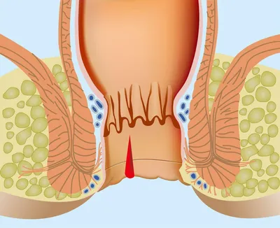 Можно ли поставить диагноз «геморрой» по симптомам? - KP.RU