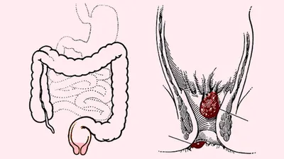 Свищи прямой кишки - лечение и удаление анальных свищей