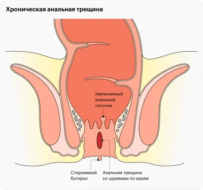 Кокцигодиния, боли в области ануса.