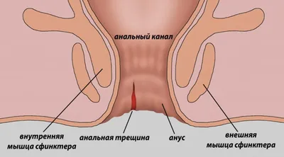 ТРЕЩИНЫ ЗАДНЕГО ПРОХОДА: СИМПТОМЫ, ЛЕЧЕНИЕ - KupfferKupffer