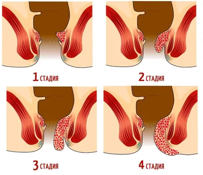 Геморрой: причины, симптомы, диагностика и лечение