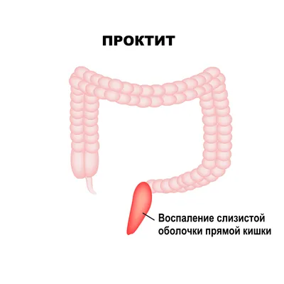 Геморрой – причины, симптомы, диагностика и способы лечения заболевания |  Клиника Будь Здоров