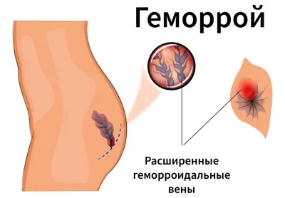 Как я удалила анальную трещину