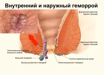 Геморрой: лечение внутреннего и внешнего геморроя у мужчин и женщин в Москве