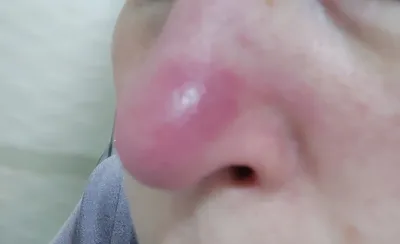 Болячка на носу фото