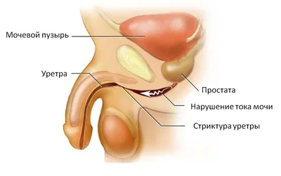 Рак полового члена: симптомы, признаки, диагностика, лечение