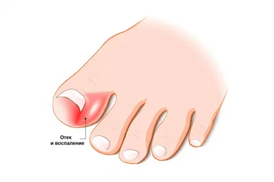 Вросший ноготь – признаки, причины, симптомы, лечение и профилактика  вросшего ногтя у взрослых | «Будь Здоров»