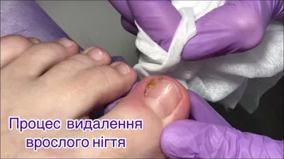 Защита пальцев: что это и какой она бывает? | Footcare