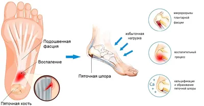 Боль в пятке - причины появления, при каких заболеваниях возникает,  диагностика и способы лечения