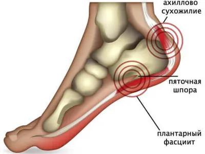 Пяточная шпора: симптомы, причины, диагностика, лечение плантарного  фасциита в Москве
