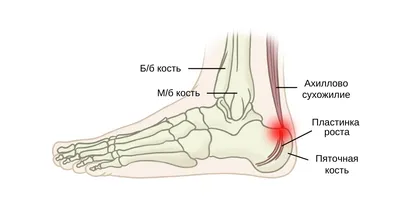 Больно наступать на пятку после сна, почему болят пятки по утрам и в  течении дня| Клиника TEMED