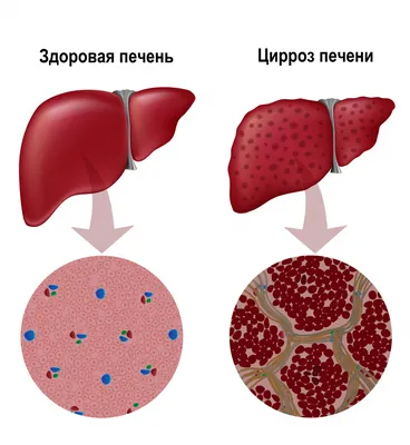 Как по внешним признакам глаз распознать больную печень