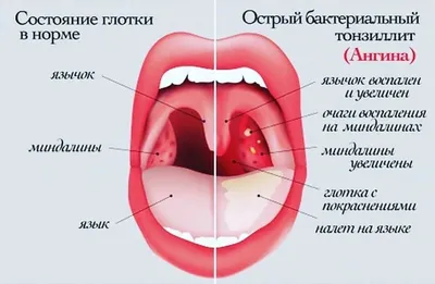 Почему может болеть горло? - Медицинский центр «Добрый Доктор»