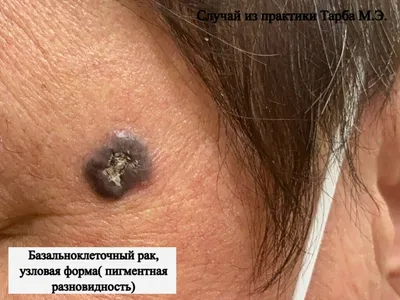 Лечение базалиомы (базальноклеточного рака) в Киеве — Derma.ua