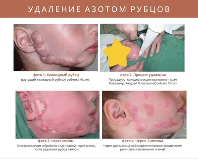 Криодеструкция в Киеве на Печерске - Coolaser Clinic