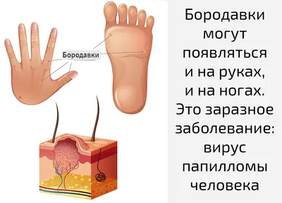 Бородавка: можно ли с ней приходить на маникюр?