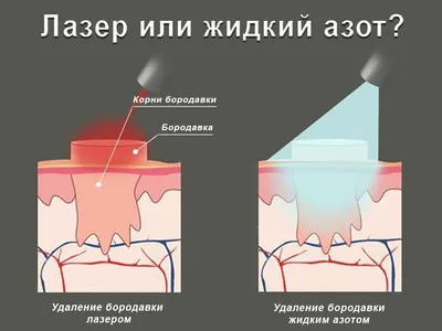 Удаление бородавок и папиллом азотом (id 103664043), заказать в Казахстане,  цена на Satu.kz