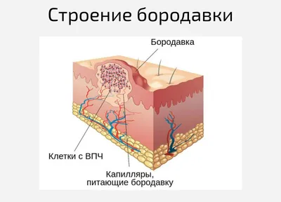 Бородавки на руках у взрослых: как избавиться и почему появляются