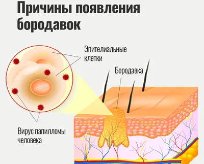 Бородавки и паппиломы на теле | Удаление и лечение лазером