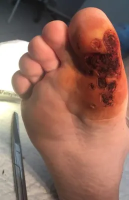 Wart on the foot of a teenager / Corns on the feet - YouTube