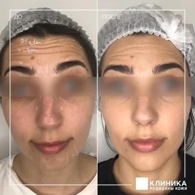 Ботокс Full Face - мгновенное преображение - Cosmetic-clinic