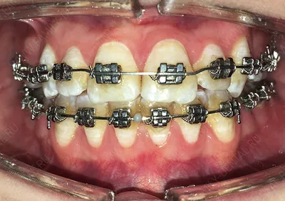 Установка брекетов до и после фото - Центр Семейной Стоматологии в Кожухово